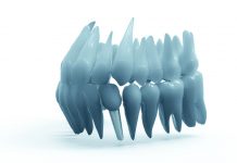implant-dentar-vodita